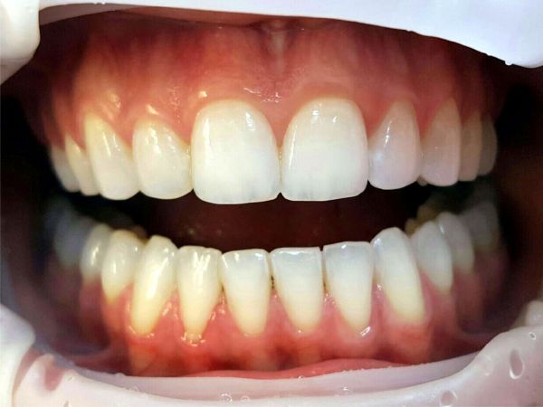 Konturing zębów górnych