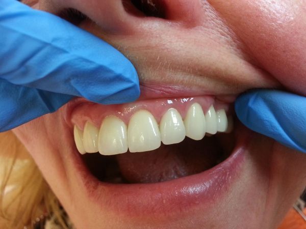 Odbudowa wszystkich zębów koronami ceramicznymi (ceramika na tlenku cyrkonu)