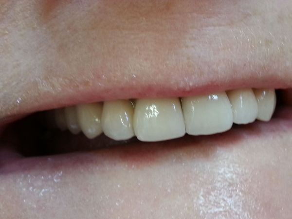 Korony ceramiczne na wszystkich zębach górnych (ceramika na stali)